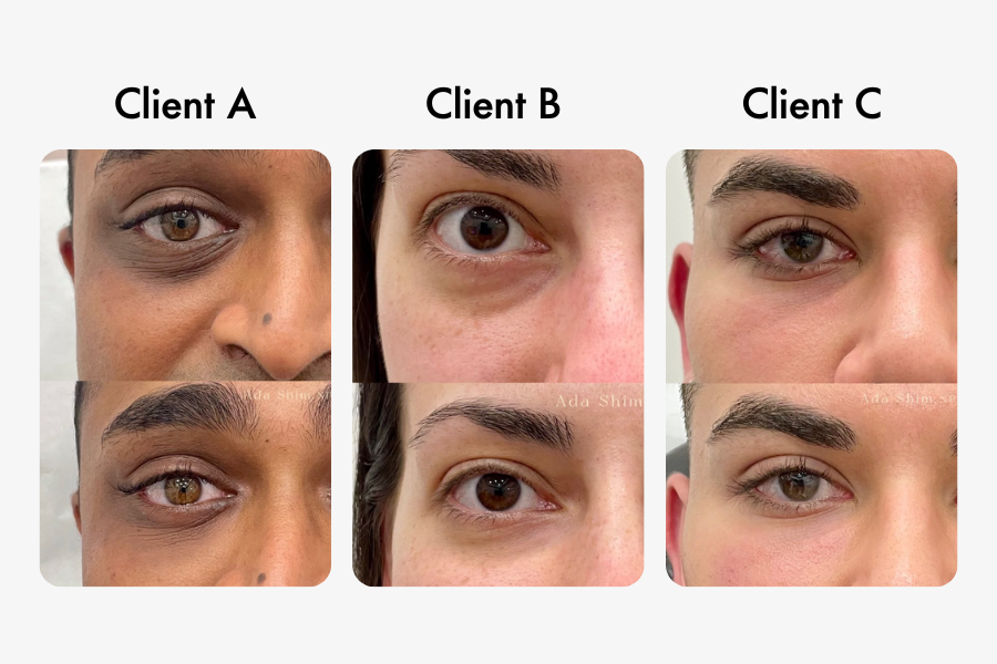 Instant Refresh The Magic of UnderEye Filler Explained